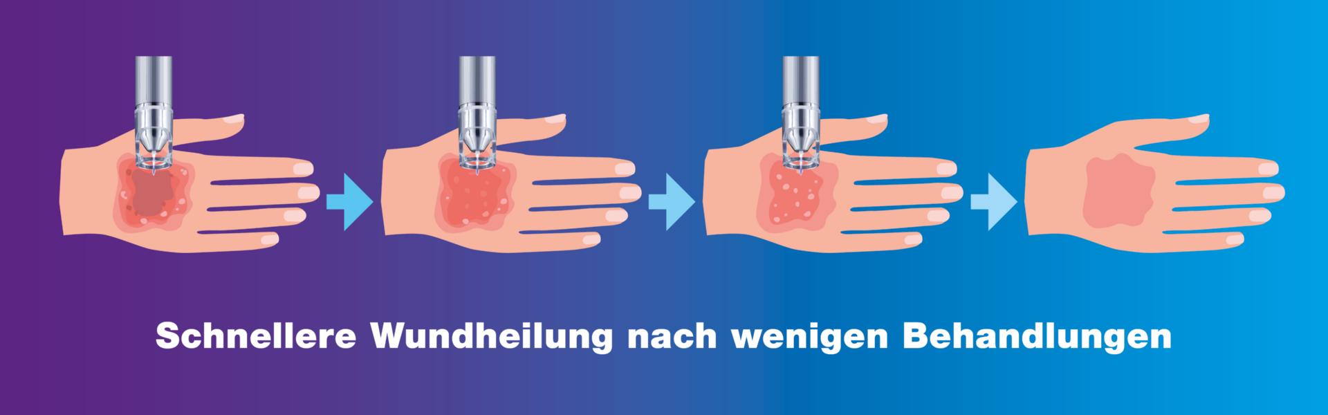 Schnellere Wundheilung mit Plasmatherapie
